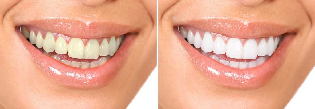 Bite Dental has zoom whitening in studio. Before and after results are typical.