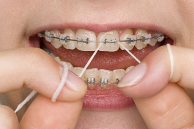 Find the right floss to use if you have dental braces or bridges