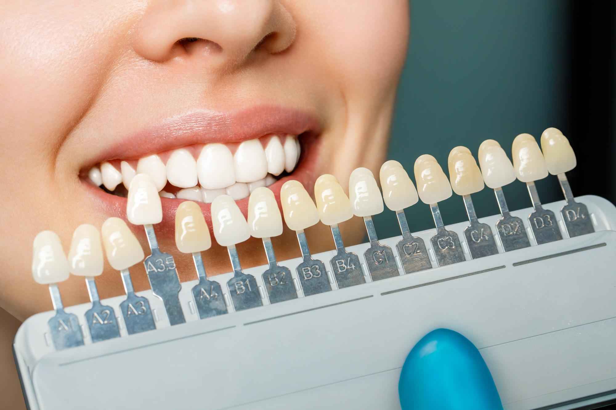 checking the shade of teeth using tooth color comparator