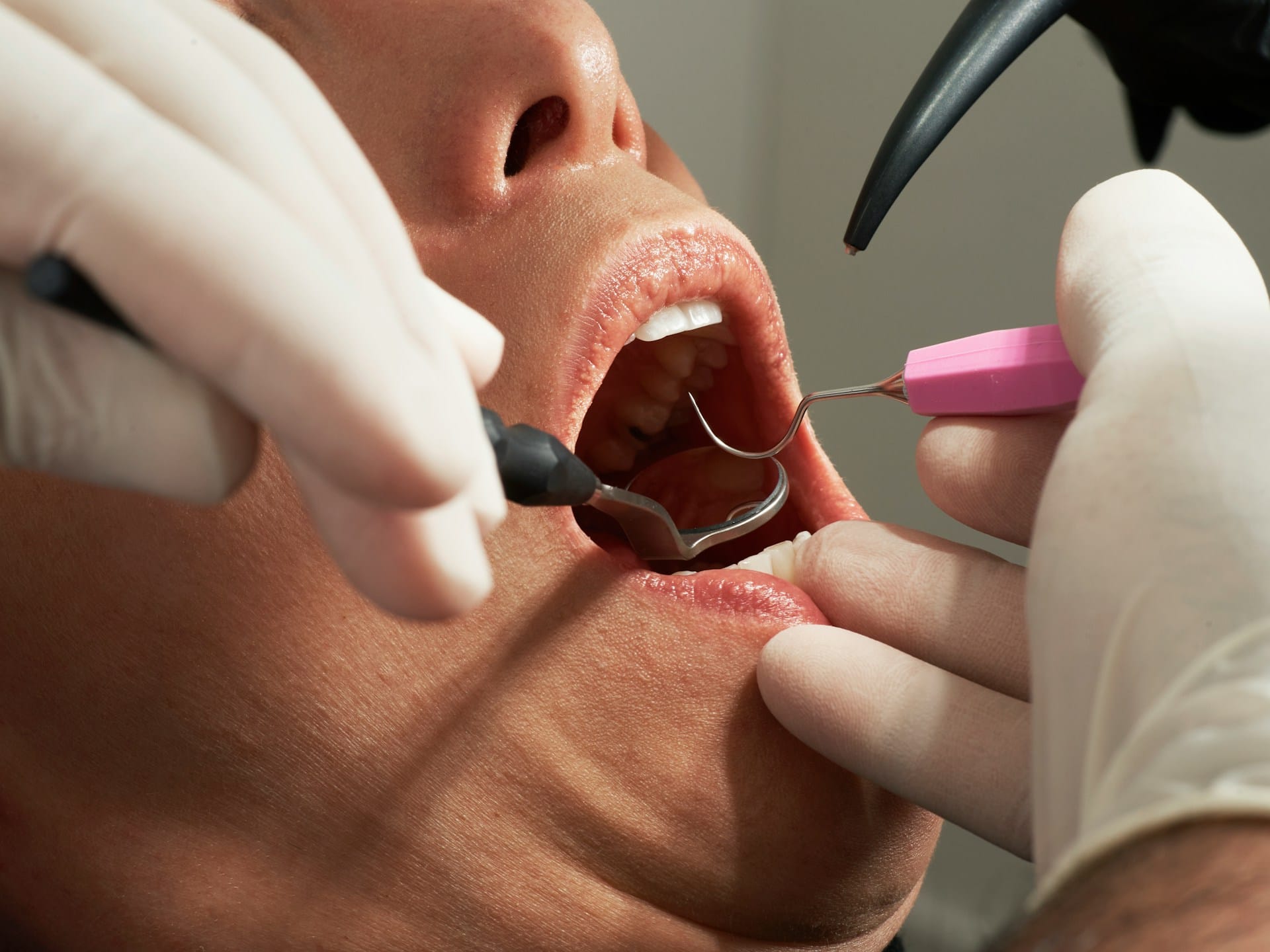 Gum Disease