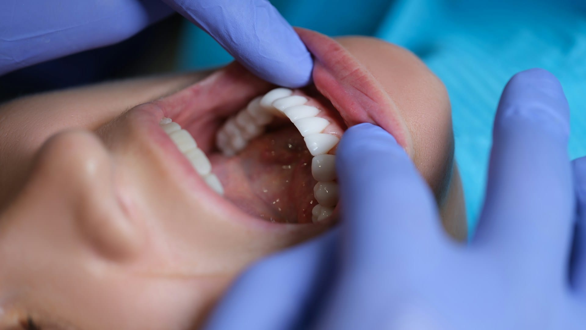 Smile Makeover