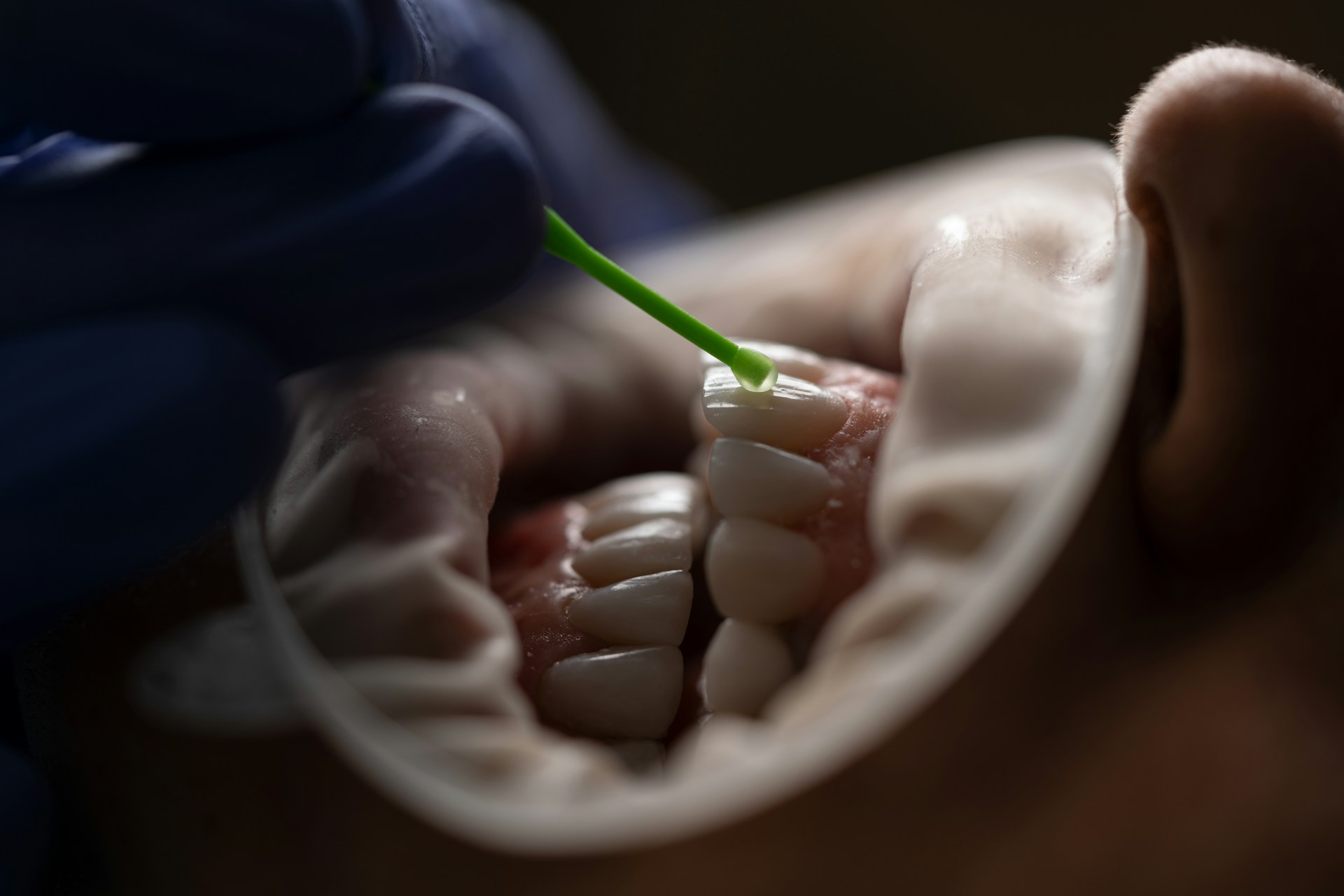 Teeth Whitening