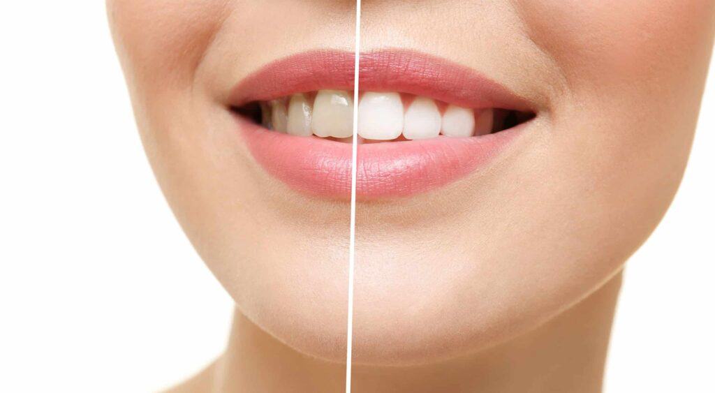 Does Teeth Whitening Work? Bite Dental Studios Brisbane City