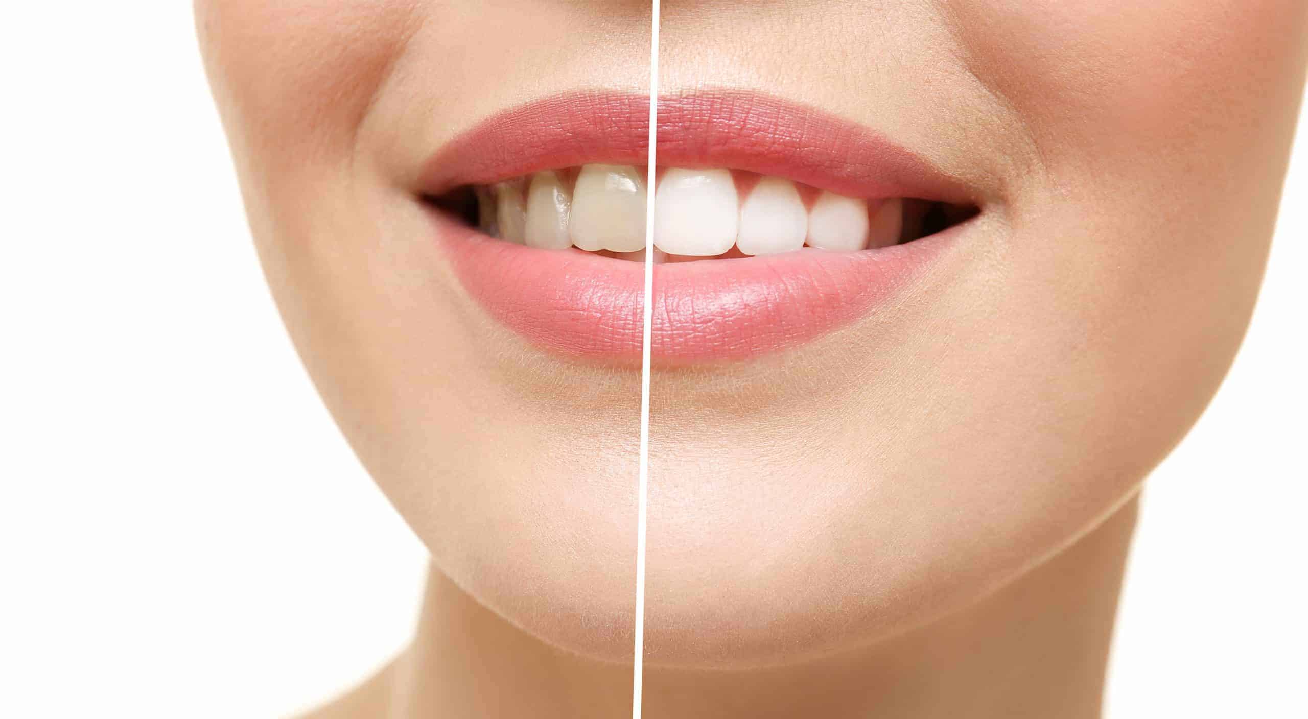 Can You Whiten Teeth with Cracks Using Philips Zoom Lamp?